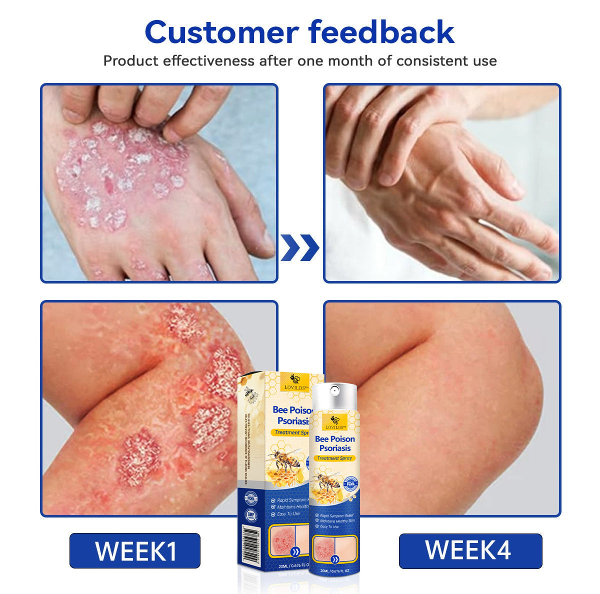 【Official Brand Store】PsoriaHeal Psoriasis Spray Pro(副本)