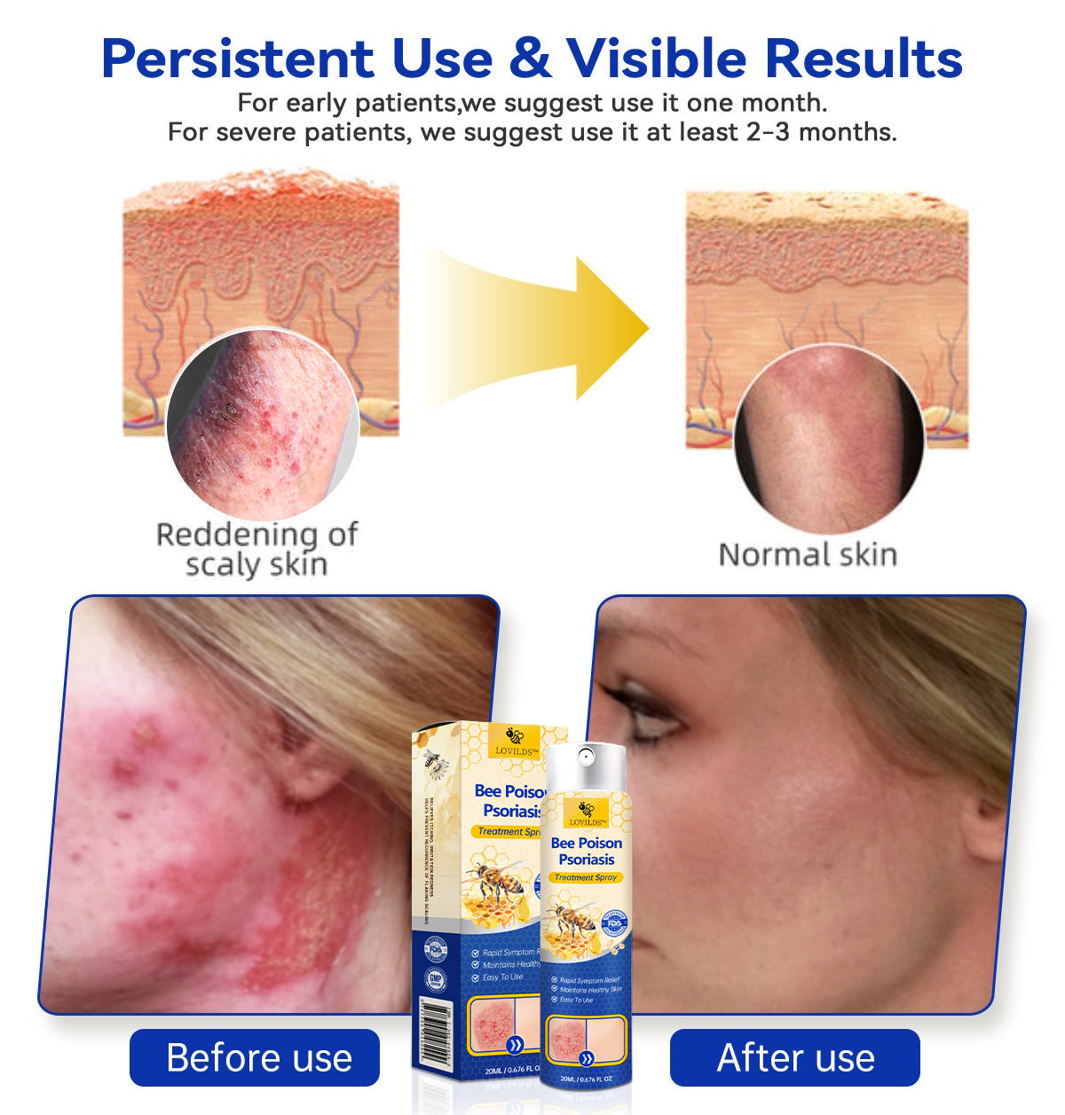 【Official Brand Store】PsoriaHeal Psoriasis Spray Pro(副本)