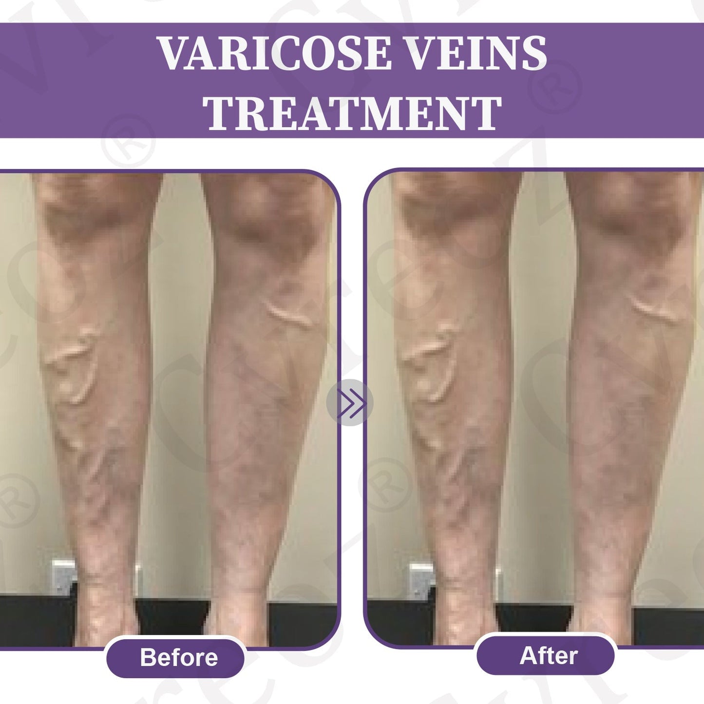🚀LOVILDS™✅Care Phyto Cream-HelpsTreat Varicose Veins,Swelling,cramps, andLeg Pain(副本)