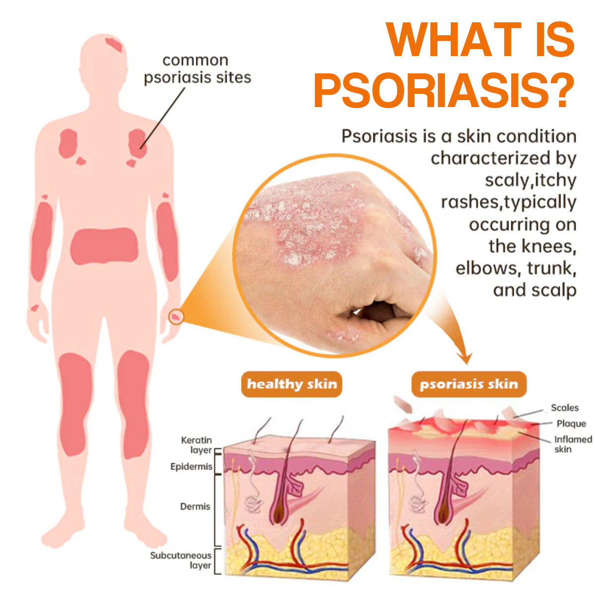 【Official Brand Store】PsoriaHeal Psoriasis Spray Pro（副本）
