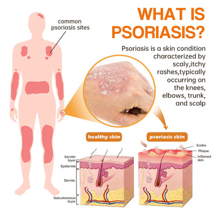 【Official Brand Store】PsoriaHeal Psoriasis Spray Pro（副本）