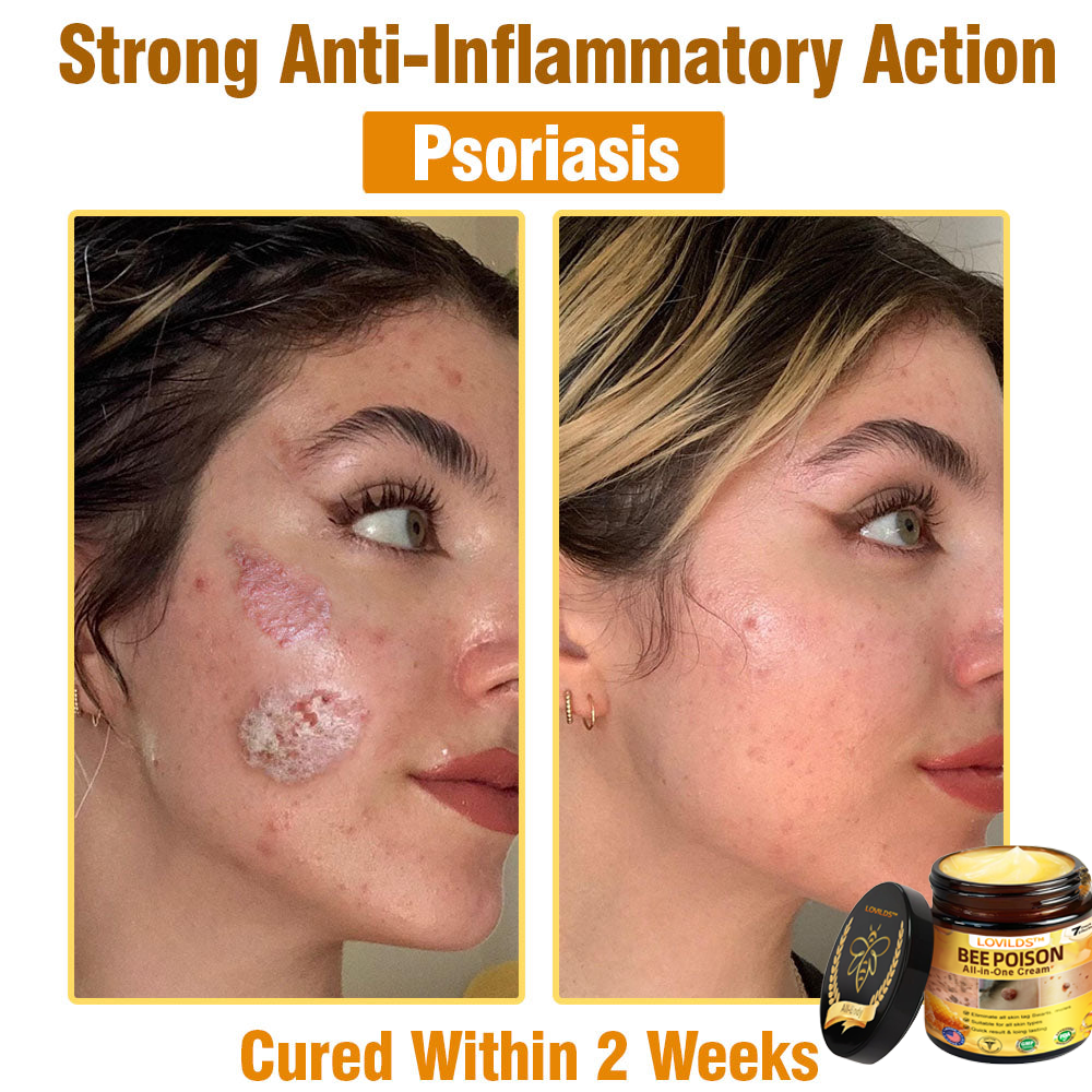LOVILDS™ Bee Poison All-in-One Cream US Dermatologist Approved（副本）