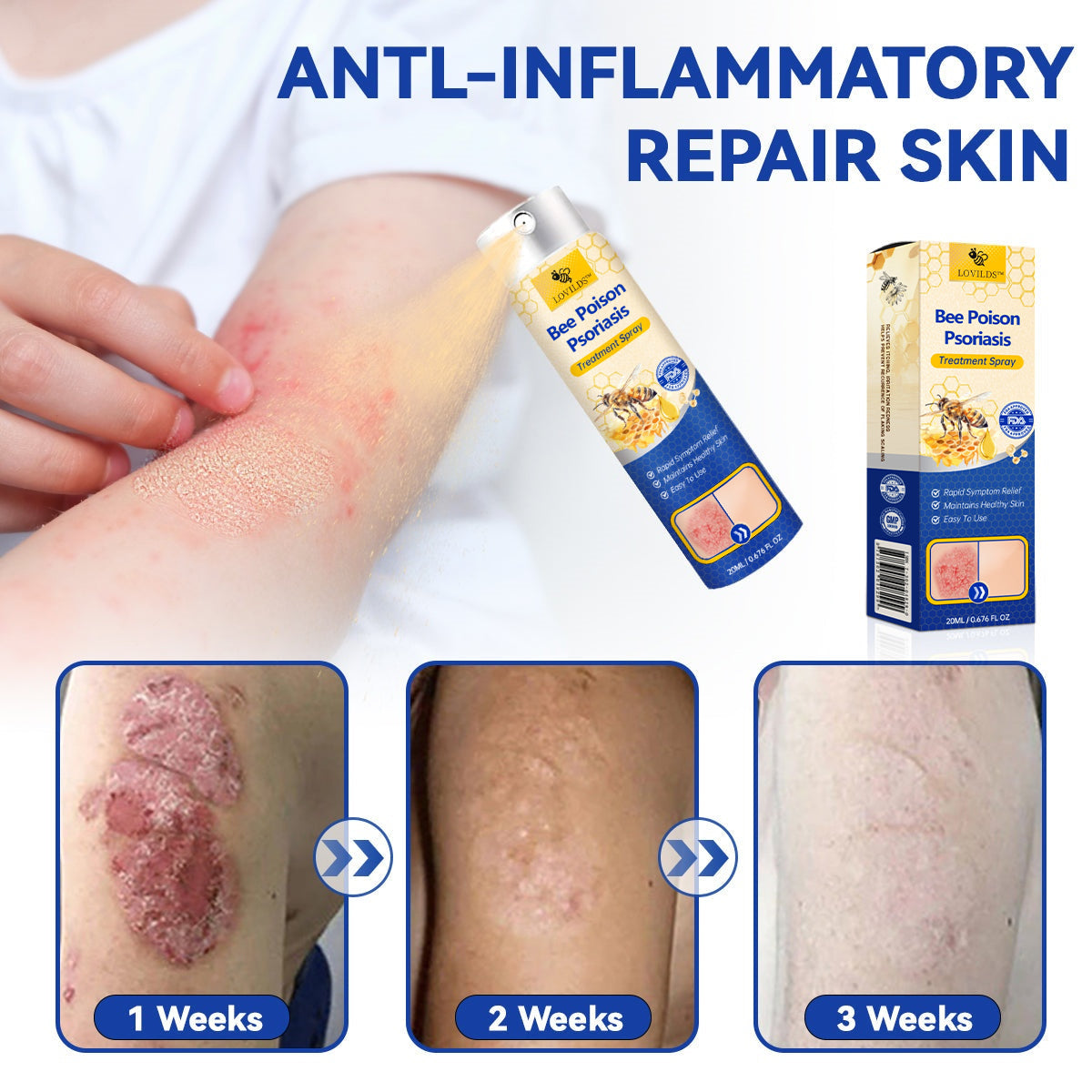 【Official Brand Store】PsoriaHeal Psoriasis Spray Pro（副本）