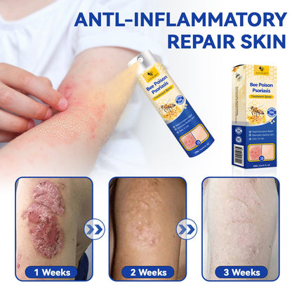 【Official Brand Store】PsoriaHeal Psoriasis Spray Pro（副本）