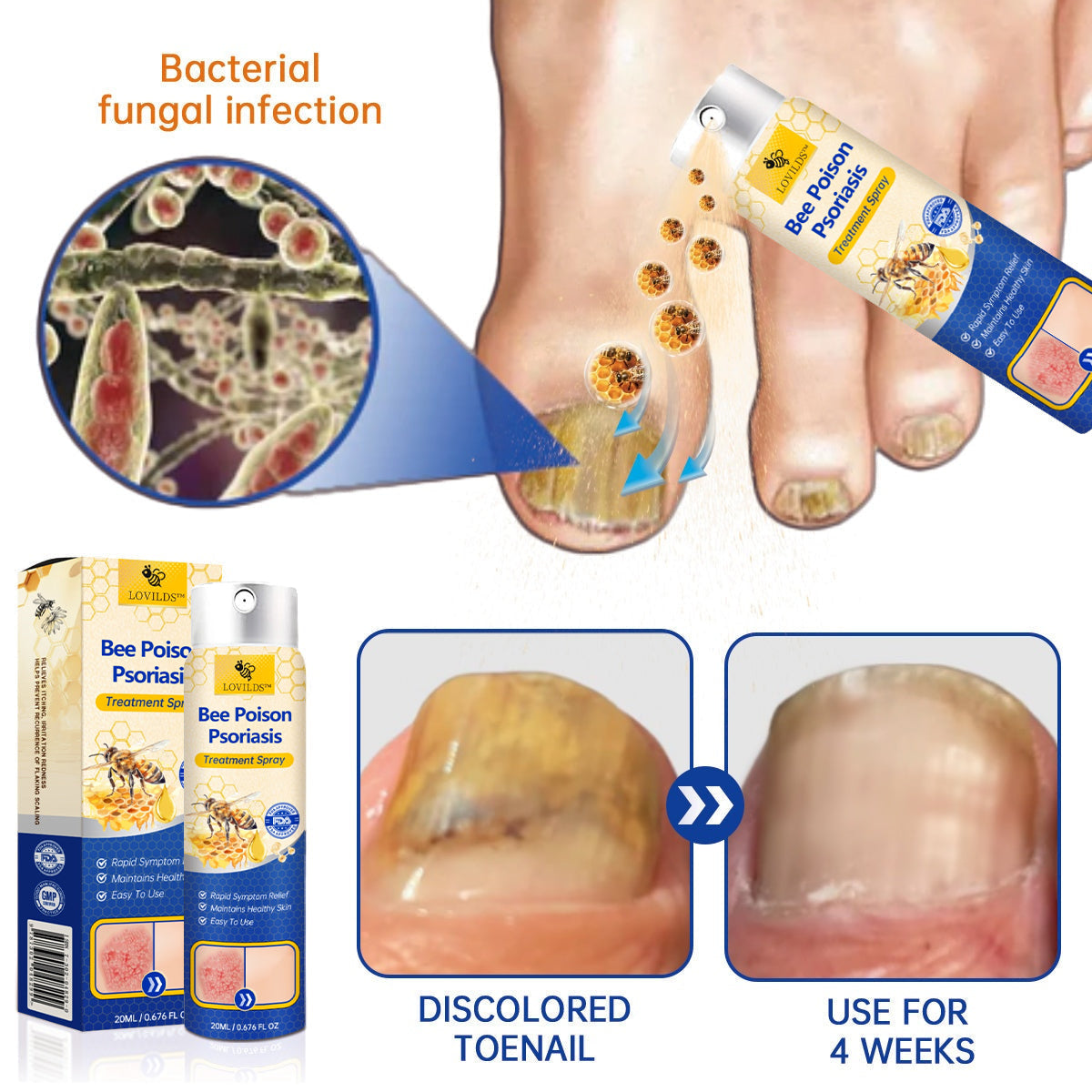 【Official Brand Store】PsoriaHeal Psoriasis Spray Pro（副本）