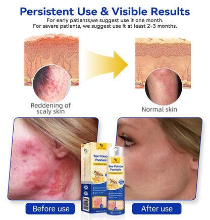 【Official Brand Store】PsoriaHeal Psoriasis Spray Pro（副本）