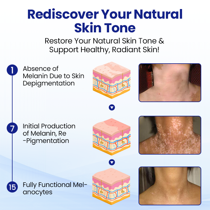 Lovilds® Vitiligo Treatment Spray（副本）
