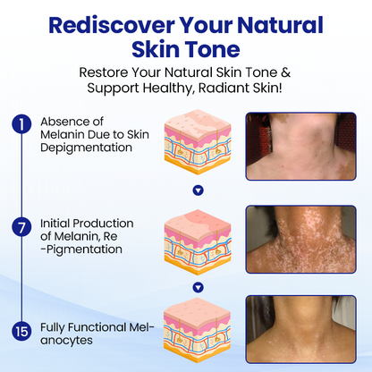 Lovilds® Vitiligo Treatment Spray（副本）