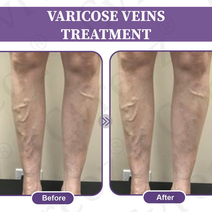 🚀LOVILDS™✅Care Phyto Cream-HelpsTreat Varicose Veins,Swelling,cramps, andLeg Pain（副本）