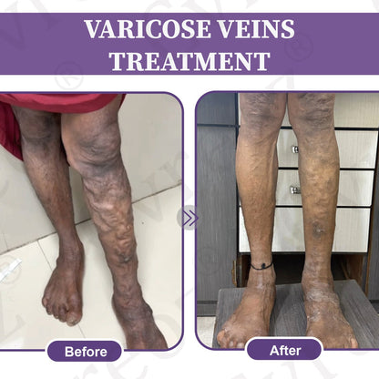 🚀LOVILDS™✅Care Phyto Cream-HelpsTreat Varicose Veins,Swelling,cramps, andLeg Pain（副本）