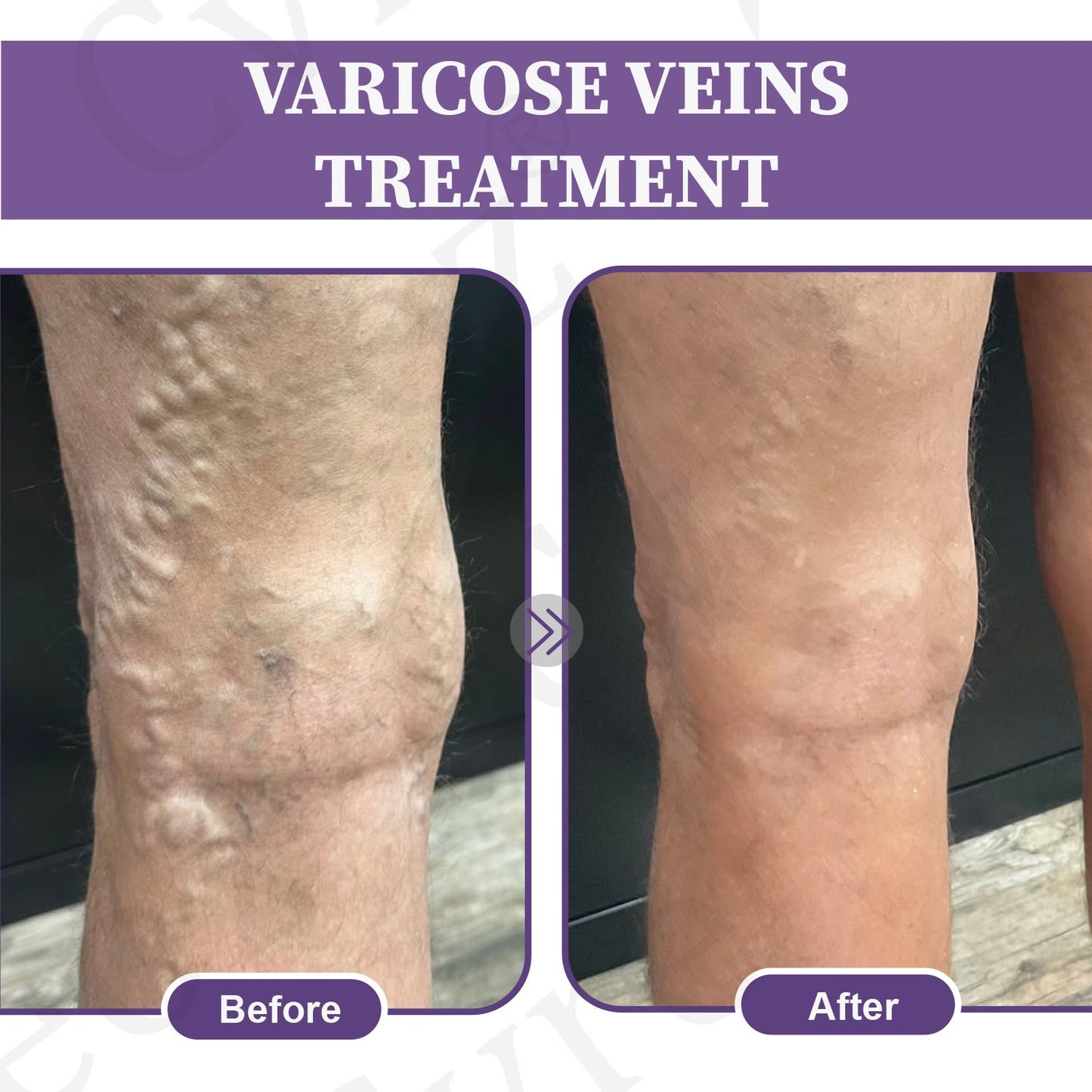 🚀LOVILDS™✅Care Phyto Cream-HelpsTreat Varicose Veins,Swelling,cramps, andLeg Pain（副本）