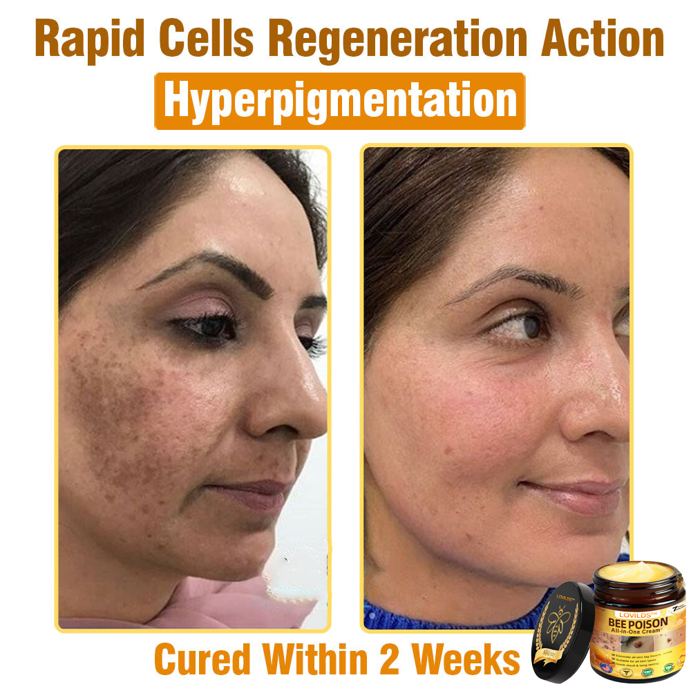 LOVILDS™ Bee Poison All-in-One Cream US Dermatologist Approved（副本）