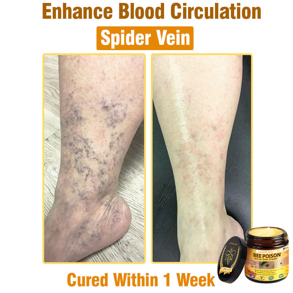 LOVILDS™ Bee Poison All-in-One Cream US Dermatologist Approved（副本）