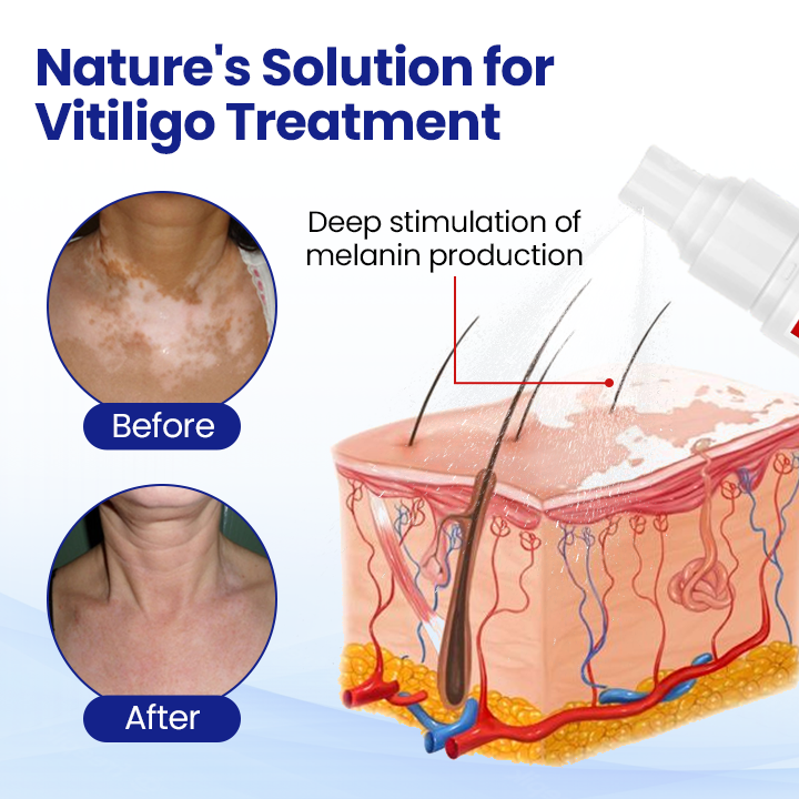 Lovilds® Vitiligo Treatment Spray（副本）