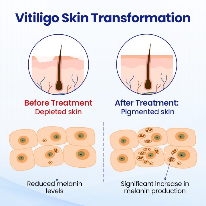 Lovilds® Vitiligo Treatment Spray（副本）