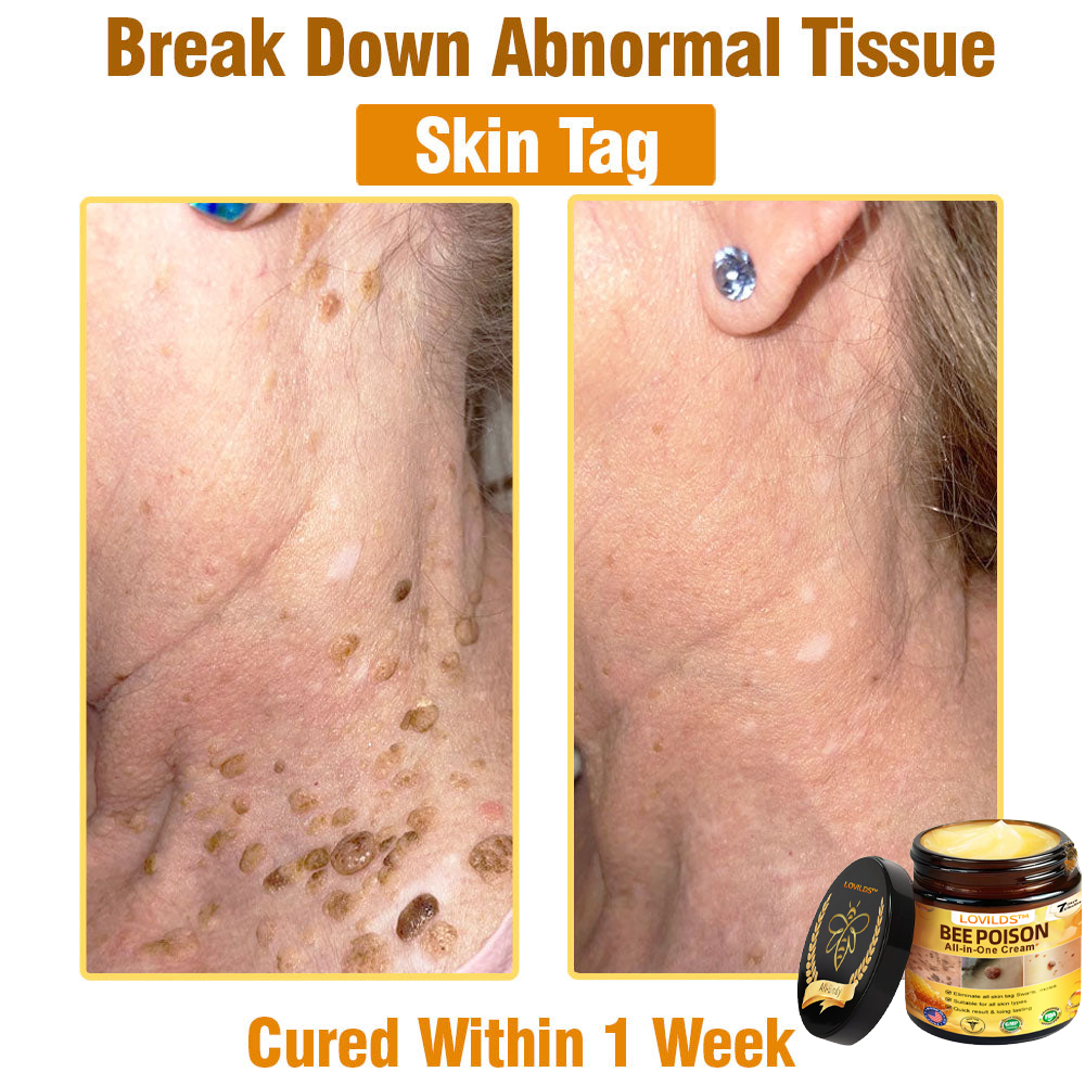 LOVILDS™ Bee Poison All-in-One Cream US Dermatologist Approved（副本）