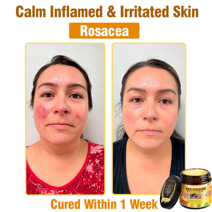 LOVILDS™ Bee Poison All-in-One Cream US Dermatologist Approved（副本）